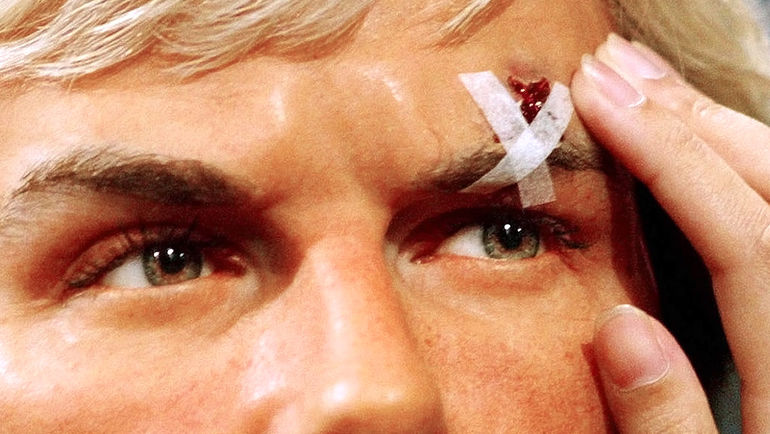 Шрам на лице Дэвида БЕКХЭМА после броска бутсы, совершенного Алексом Фергюсоном. Фото REUTERS