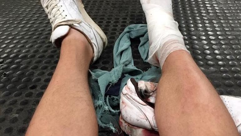 Один из пострадавших в римском метро серьезно травмировал ногу. Фото Телеграм-канал OF news
