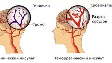 Признаки инсульта что делать до приезда скорой