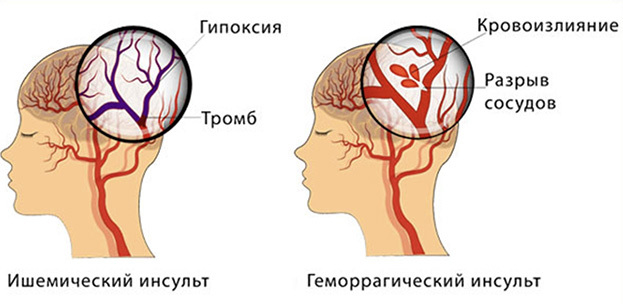 Прединсульт симптомы первые признаки у мужчин что делать