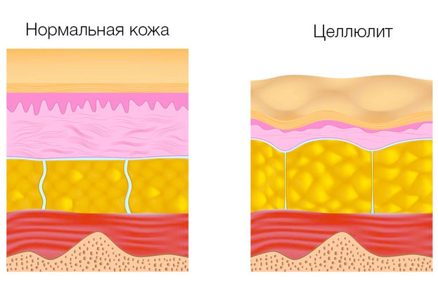 Как выглядит целлюлит фото