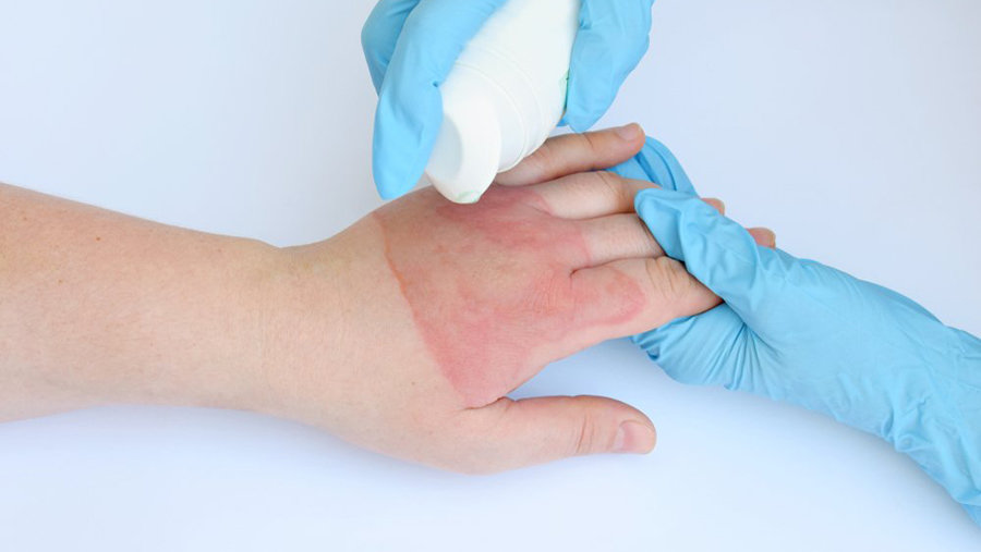 Ожоги кожи: правила первой помощи и лечения