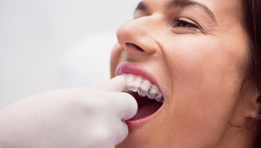 Стоматолог рассказала, эффективны ли элайнеры для выпрямления зубов